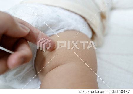 嬰兒大腿皮膚和小痣的特寫。 嬰兒大腿皮膚和小痣的特寫。 133150487