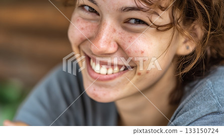 Joyful young woman with freckles and acne smiling naturally. Authentic portrait promoting real beauty, acne positivity and self-acceptance 133150724