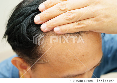 Bald head in man, hair loss treatment health problem. 133153562