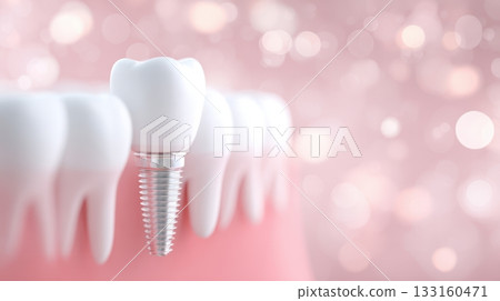 Dental implant placed among healthy teeth, showcasing modern dental technology and oral health care in a vibrant, soft-focus background 133160471