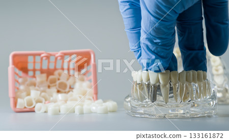 Dental Crown Placement on Implant Model with Gloved Hand 133161872
