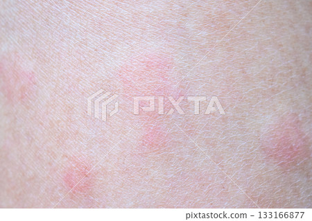Skin allergy rash dermatitis texture close up Skin allergy rash dermatitis texture close up 133166877