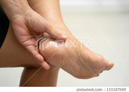 Asian woman care feet with cracked and dry heel skin cream at home. 133187089