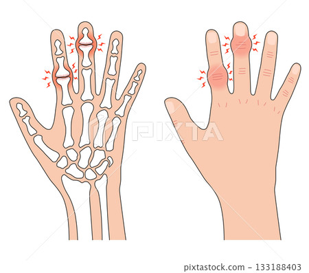 赫伯登節點和布沙爾節點 赫伯登節點和布沙爾節點 133188403