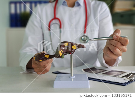 Doctor with human Liver anatomy model. Liver cancer and Tumor, Jaundice, Viral Hepatitis A, B, C, D, E 133195171