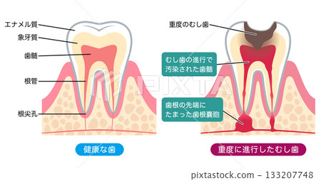 健康的牙齒和嚴重的齲齒：牙齒的內部結構 133207748