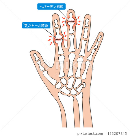 赫伯登節點和布沙爾節點 赫伯登節點和布沙爾節點 133207845