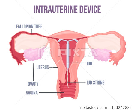 Lud. Intrauterine device placement in uterus, female contraception birth control copper or hormonal coil mirena iucd medical education preventive pregnancy neat vector illustration Lud. Intrauterine device placement in uterus, female contraception birth control copper or hormonal coil mirena iucd medical education preventive pregnancy neat vector illustration 133242883