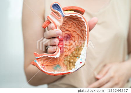 Stomach disease, Asian woman holding anatomy model for treatment in hospital. 133244227
