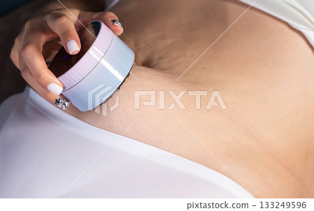 Girl gives herself an anti-cellulite massage on her stomach with a portable vacuum massager, close-up Girl gives herself an anti-cellulite massage on her stomach with a portable vacuum massager, close-up 133249596