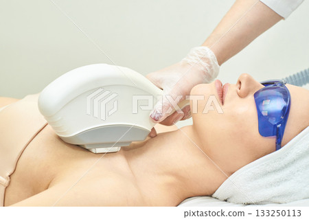 Female receiving laser hair removal on chest area with protective glasses Female receiving laser hair removal on chest area with protective glasses 133250113