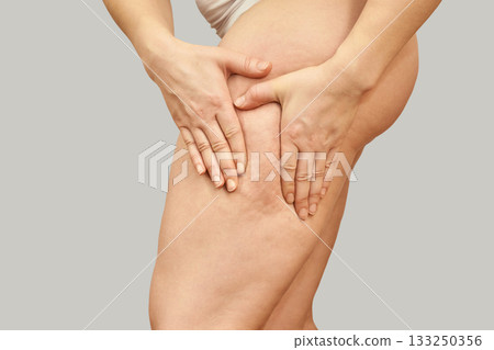 Female adult caucasian examining thigh cellulite against neutral background Female adult caucasian examining thigh cellulite against neutral background 133250356