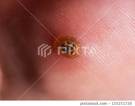 Detailed Image Of Verruca On A Human Toe. An Extreme Close-Up Highlights The Skin Texture And Wart. 133251720