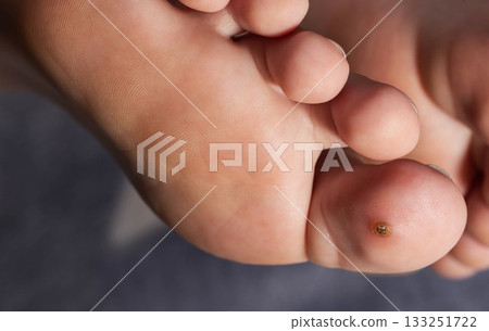 Human Foot With A Plantar Wart On The Toe. The Wider Angle Shows The Wart In Context. 133251722