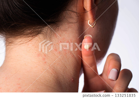 Medicinal cream on a girl's finger against the background of an ear and neck with red pimples and rashes, close-up Medicinal cream on a girl's finger against the background of an ear and neck with red pimples and rashes, close-up 133251835