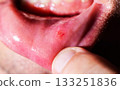 Close-up of a painful ulcer inside the mouth on a man's lip, macro, stomatitis 133251836