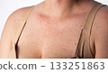 Red pimples and rashes on the skin of a woman's chest, close-up, allergic reaction to medication, dermatology 133251863