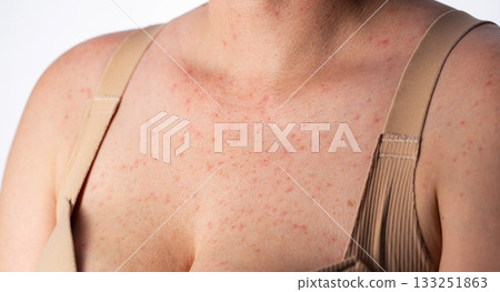 Red pimples and rashes on the skin of a woman's chest, close-up, allergic reaction to medication, dermatology 133251863