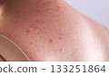 Red pimples and rashes on female skin. Concept of chronic dermatological diseases, allergy to drugs, eczema 133251864