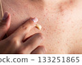 Medicinal anti-inflammatory cream for eliminating rashes and pimples on the skin of the body, close-up 133251865
