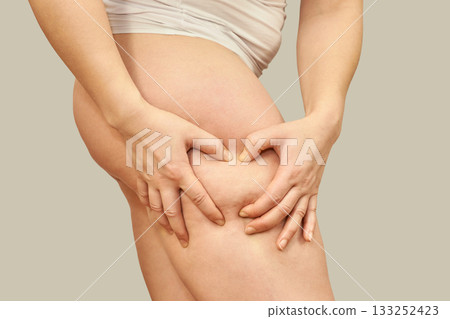 Female adult showing cellulite on thigh and skin texture close-up against Female adult showing cellulite on thigh and skin texture close-up against 133252423