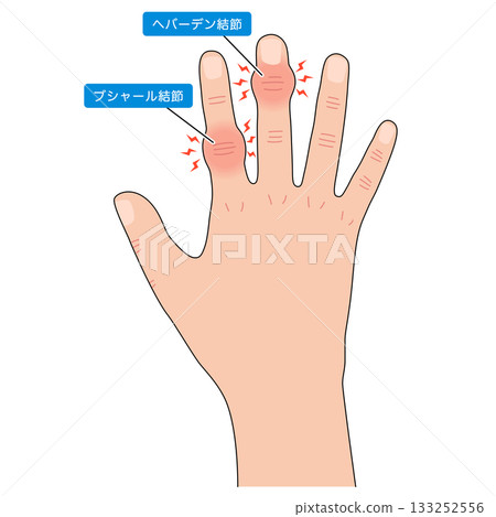 赫伯登節點和布沙爾節點 赫伯登節點和布沙爾節點 133252556