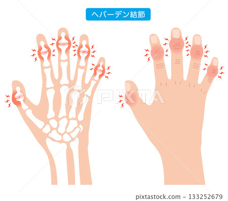 赫伯登結節:一種手指關節疾病 赫伯登結節:一種手指關節疾病 133252679