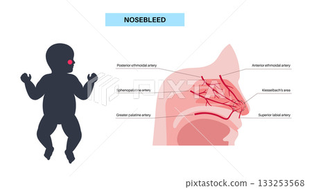 Nosebleed medical poster Nosebleed medical poster 133253568
