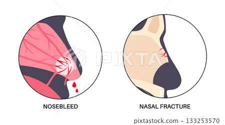 Nasal fracture poster Nasal fracture poster 133253570