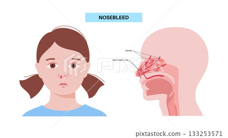 Nosebleed medical poster Nosebleed medical poster 133253571