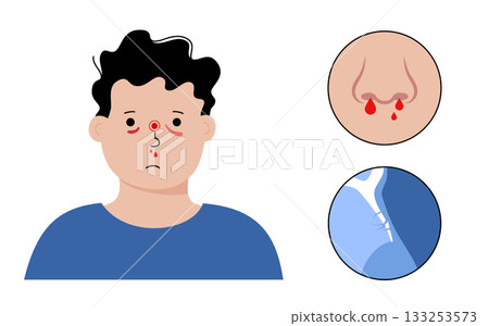 Nasal fracture poster 133253573