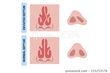 Deviated septum poster Deviated septum poster 133253576