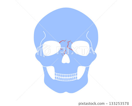 Nasal fracture poster 133253578