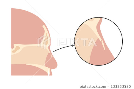 Nasal fracture poster Nasal fracture poster 133253580