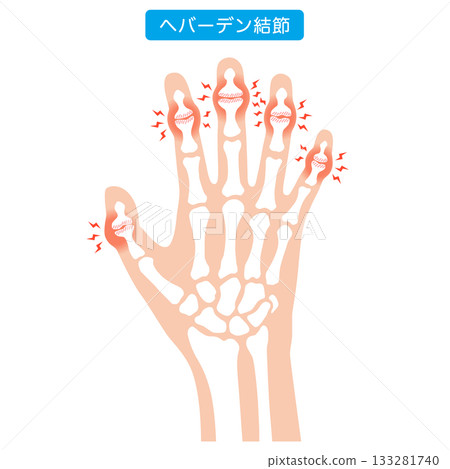 赫伯登結節:一種手指關節疾病 赫伯登結節:一種手指關節疾病 133281740