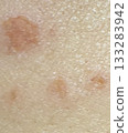 Burn scar skin close-up 133283942