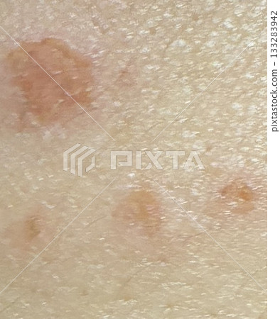 Burn scar skin close-up 133283942