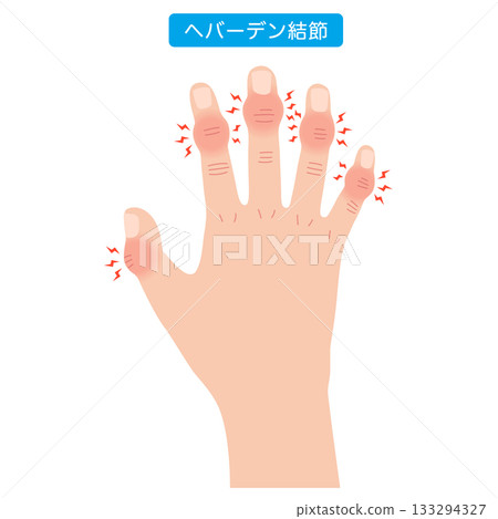 赫伯登結節:一種手指關節疾病 赫伯登結節:一種手指關節疾病 133294327