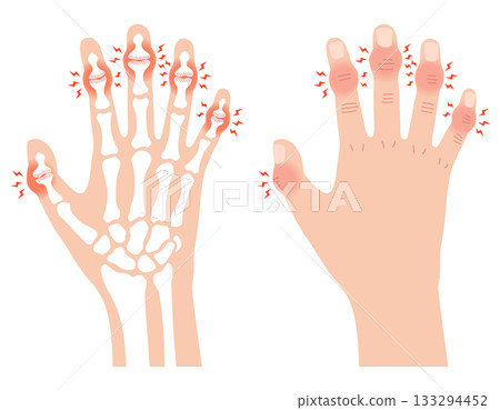 赫伯登結節:一種手指關節疾病 赫伯登結節:一種手指關節疾病 133294452