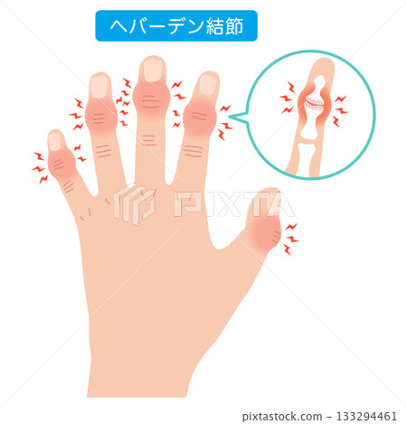赫伯登結節:一種手指關節疾病 赫伯登結節:一種手指關節疾病 133294461