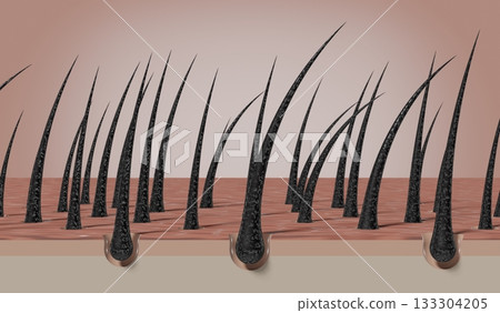 Dried and damaged hair follicles - 3D illustration 133304205