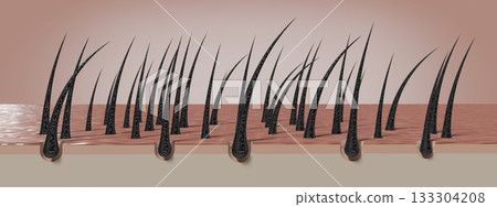 Dried and damaged hair follicles - 3D illustration 133304208
