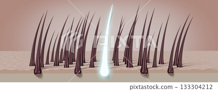 Hair follicles - regeneration concept - 3D illustration 133304212