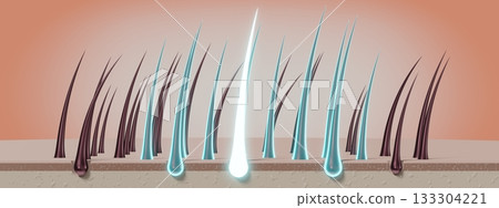 Hair follicles - regeneration concept - 3D illustration Hair follicles - regeneration concept - 3D illustration 133304221