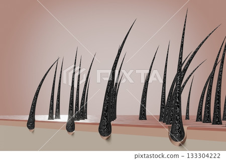 Dried and damaged hair follicles - 3D illustration 133304222