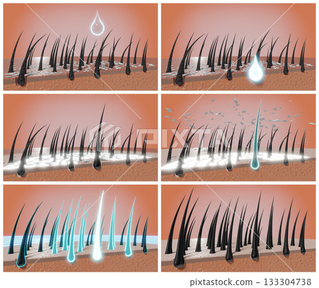 Hair follicles and dandruff - steps in therapy - 3D illustration Hair follicles and dandruff - steps in therapy - 3D illustration 133304738