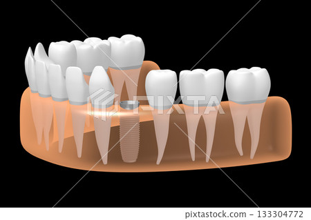 Tooth implant, other healthy teeth and gum - 3D illustration Tooth implant, other healthy teeth and gum - 3D illustration 133304772