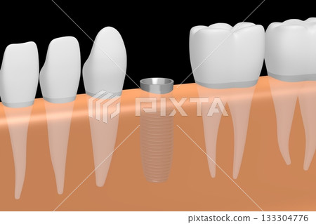 Tooth implant, other healthy teeth and gum - 3D illustration 133304776