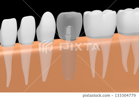 Tooth implant, other healthy teeth and gum - 3D illustration Tooth implant, other healthy teeth and gum - 3D illustration 133304779