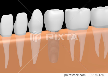 Tooth implant, other healthy teeth and gum - 3D illustration 133304780